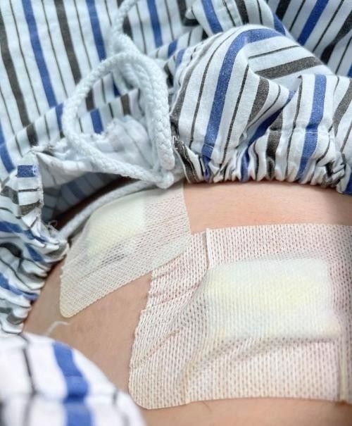 爛尾手術后如何預防感染？（南陽醫專一附院闌尾炎手術后的護理）