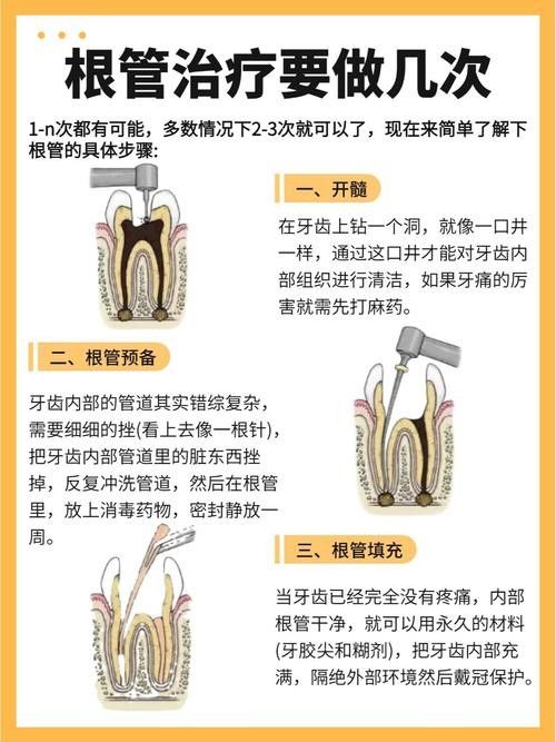 根管治療期間如何保持口腔衛(wèi)生（李祥副主任醫(yī)師三甲根管治療期間飲食注意事項有哪些） 根管治療期間如何保持口腔衛(wèi)生（李祥副主任醫(yī)師三甲根管治療期間飲食注意事項有哪些） 龍魚百科 第3張