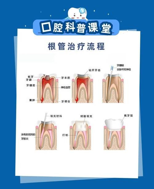 根管治療期間如何保持口腔衛(wèi)生（李祥副主任醫(yī)師三甲根管治療期間飲食注意事項有哪些） 根管治療期間如何保持口腔衛(wèi)生（李祥副主任醫(yī)師三甲根管治療期間飲食注意事項有哪些） 龍魚百科 第4張