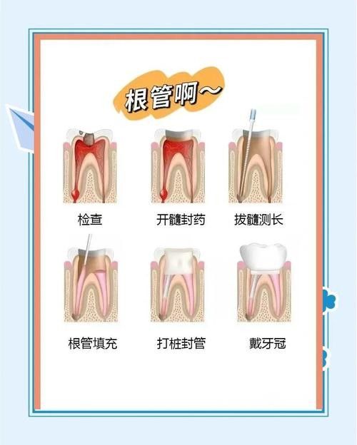 根管治療期間如何保持口腔衛(wèi)生（李祥副主任醫(yī)師三甲根管治療期間飲食注意事項有哪些） 根管治療期間如何保持口腔衛(wèi)生（李祥副主任醫(yī)師三甲根管治療期間飲食注意事項有哪些） 龍魚百科 第6張