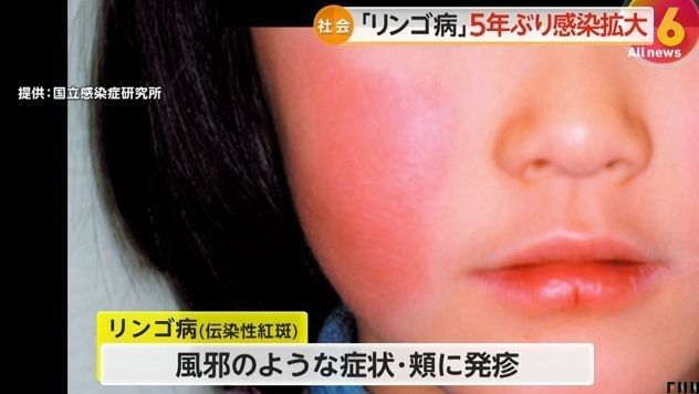 紅點(diǎn)病有哪些癥狀？（紅點(diǎn)病的癥狀具體表現(xiàn)是什么劉愛(ài)華主任醫(yī)師三甲聽(tīng)）