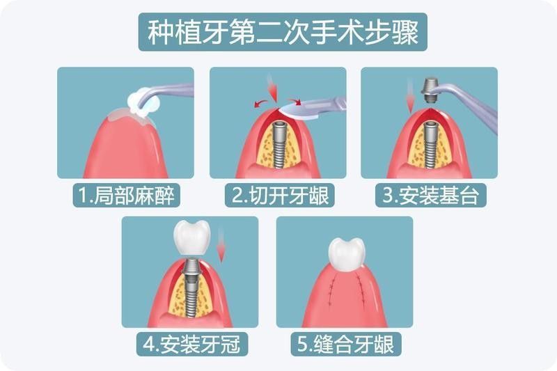 二次手術后如何護理（二次手術后的護理）