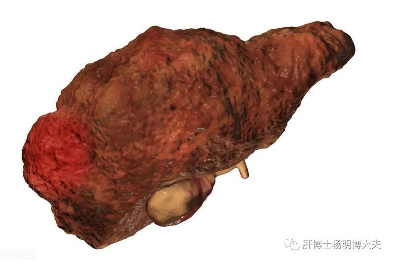 腹水治療期間需要禁食嗎
