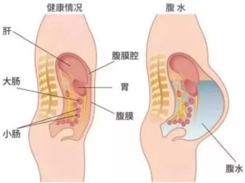 如何調(diào)整水質(zhì)以預(yù)防腹水（肝硬化腹水患者如何預(yù)防腹水？）