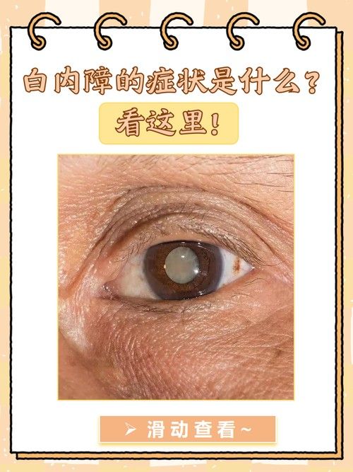 如何判斷鉆石眼是否嚴(yán)重？（判斷鉆石眼是否嚴(yán)重需要綜合考慮多個因素，眼科醫(yī)生綜合評估） 如何判斷鉆石眼是否嚴(yán)重？（判斷鉆石眼是否嚴(yán)重需要綜合考慮多個因素，眼科醫(yī)生綜合評估） 龍魚百科 第5張