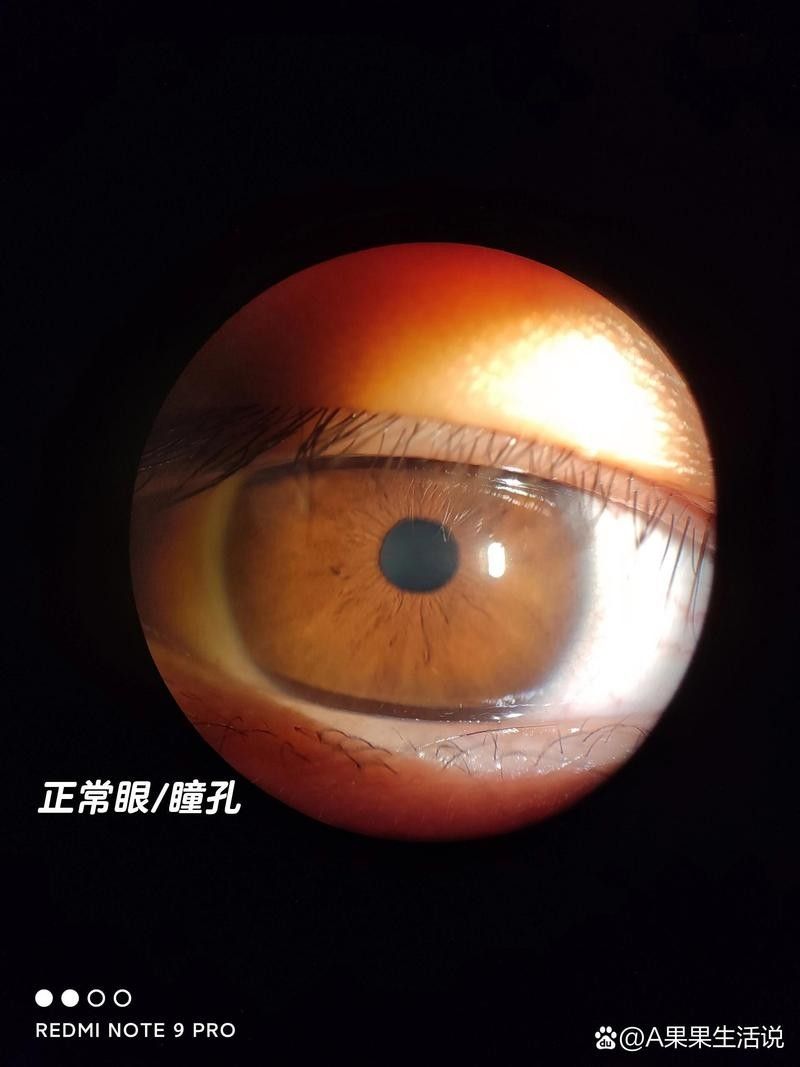 如何判斷鉆石眼是否嚴(yán)重？（判斷鉆石眼是否嚴(yán)重需要綜合考慮多個因素，眼科醫(yī)生綜合評估） 如何判斷鉆石眼是否嚴(yán)重？（判斷鉆石眼是否嚴(yán)重需要綜合考慮多個因素，眼科醫(yī)生綜合評估） 龍魚百科 第6張