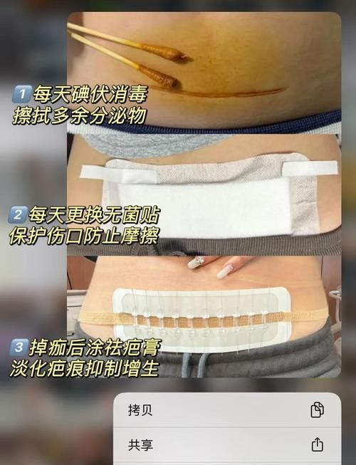 抽腹水后如何預防感染？