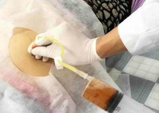 抽腹水后如何預防感染？