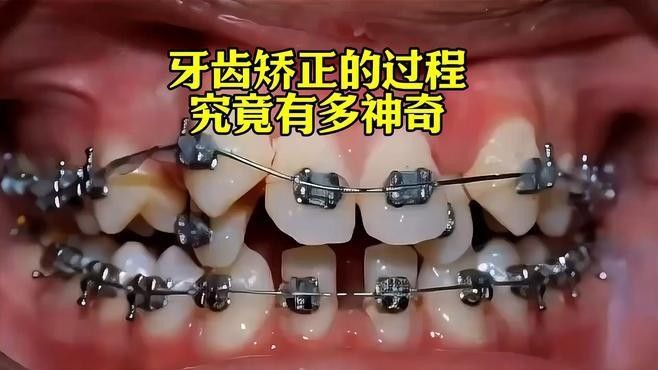 非手術矯正方法需要多長時間見效（牙齒矯正需要多長時間） 非手術矯正方法需要多長時間見效（牙齒矯正需要多長時間） 龍魚百科 第2張