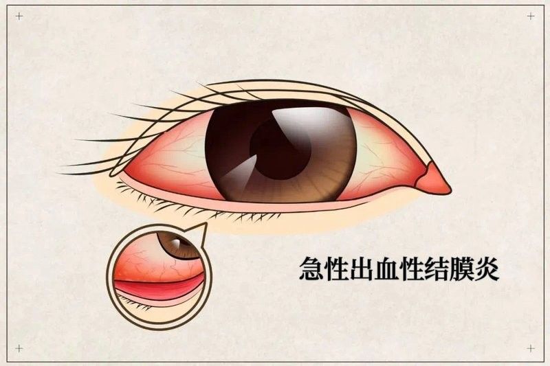 紅龍蒙眼病的治療方法有哪些（紅眼病的治療方法） 紅龍蒙眼病的治療方法有哪些（紅眼病的治療方法） 龍魚百科 第3張