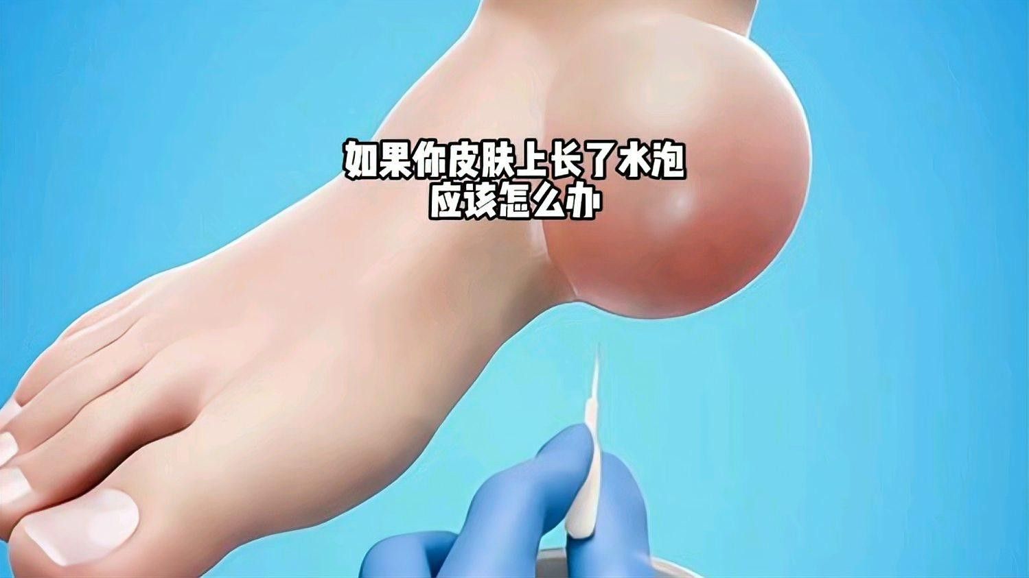 水泡病有哪些治療方法（如果你的皮膚上長了一個水泡,應該怎么辦） 水泡病有哪些治療方法（如果你的皮膚上長了一個水泡,應該怎么辦） 龍魚百科 第3張