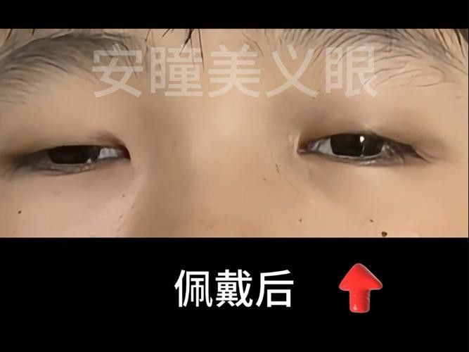 哪種材質的義眼最好？