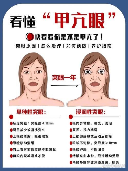 如何預防單眼凸出病的發(fā)生？