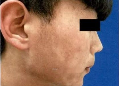 白點病傳染嗎？（皮膚上出現白斑是怎么回事皮膚上出現白斑是怎么回事）
