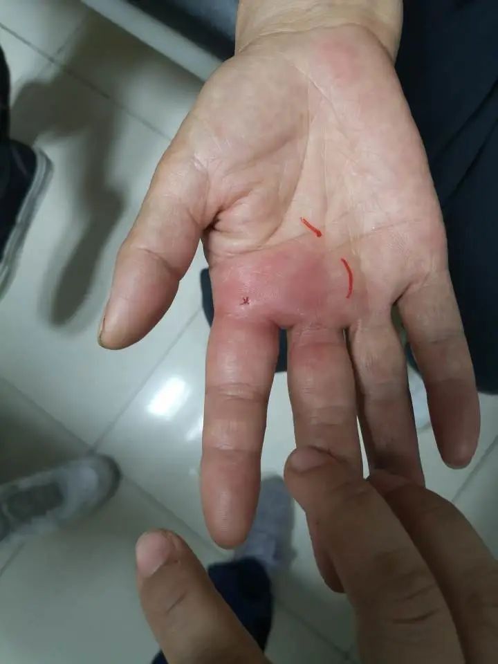 被金龍魚咬傷需要打破傷風嗎（被金龍魚咬傷需要打破傷風疫苗嗎） 被金龍魚咬傷需要打破傷風嗎（被金龍魚咬傷需要打破傷風疫苗嗎） 龍魚百科 第2張