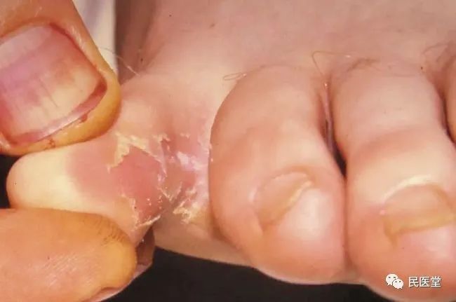 爛腳病多久會好？（劉雯敏副主任醫師三甲腳氣多久能治好劉雯敏副主任醫師三甲腳氣）