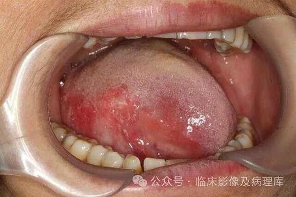 龍魚嘴起肉疙瘩圖解（魚嘴起肉疙瘩圖解）