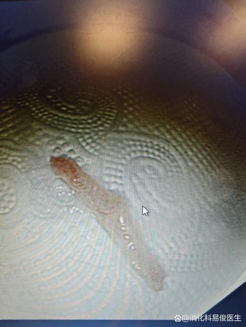 龍魚嘴起肉疙瘩圖解（魚嘴起肉疙瘩圖解）