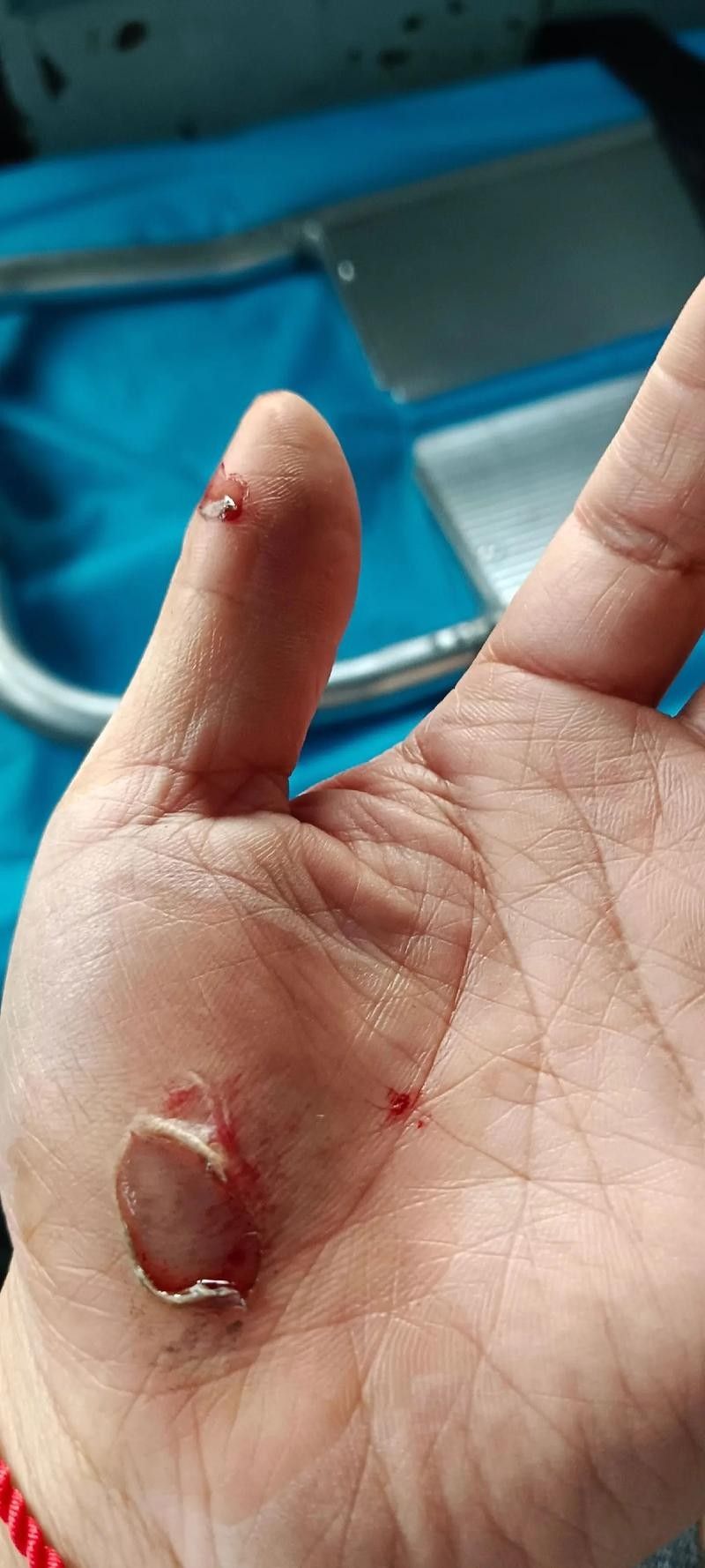如何促進傷口愈合（傷口怎么樣愈合快）