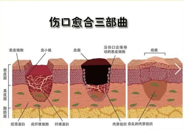 如何促進傷口愈合（傷口怎么樣愈合快）