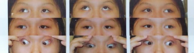蒙眼治療一般需要多久？（蒙眼治療的持續時間）