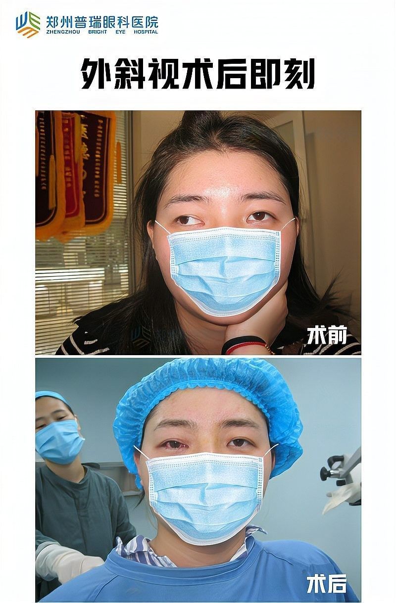 蒙眼治療一般需要多久？（蒙眼治療的持續時間）