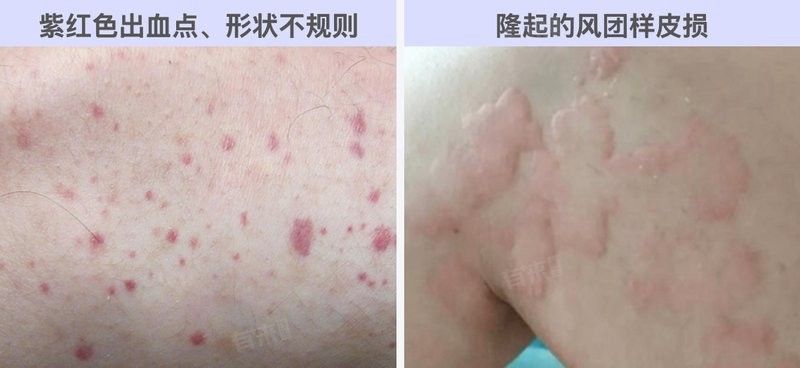 敗血癥癥狀有哪些？（楊柳副主任醫師三甲敗血癥有哪些癥狀有哪些癥狀） 敗血癥癥狀有哪些？（楊柳副主任醫師三甲敗血癥有哪些癥狀有哪些癥狀） 龍魚百科 第5張