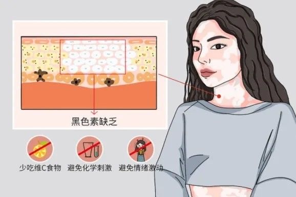 白點病藥物治療后多久見效（白癜風吃藥多久能治愈劉雯敏副主任醫師三甲白斑治療多久見效）