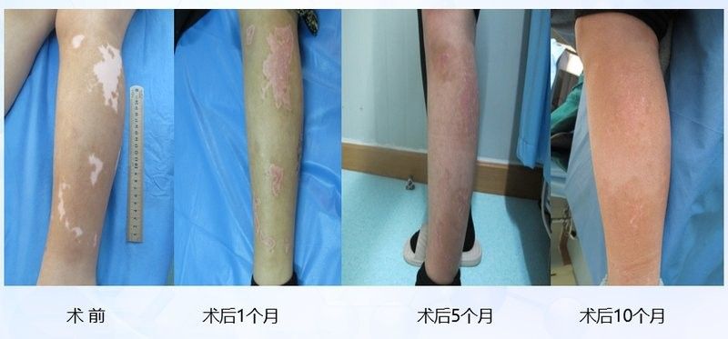 白點病藥物治療后多久見效（白癜風吃藥多久能治愈劉雯敏副主任醫師三甲白斑治療多久見效）