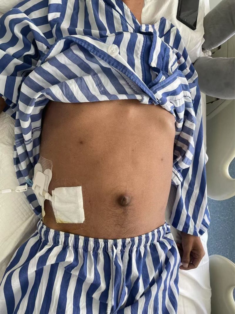 感染性腹水和代謝性腹水的典型病例（感染性腹水與代謝性腹水的區(qū)別）