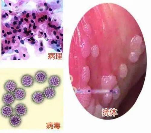 能提供這四種病的圖片嗎？