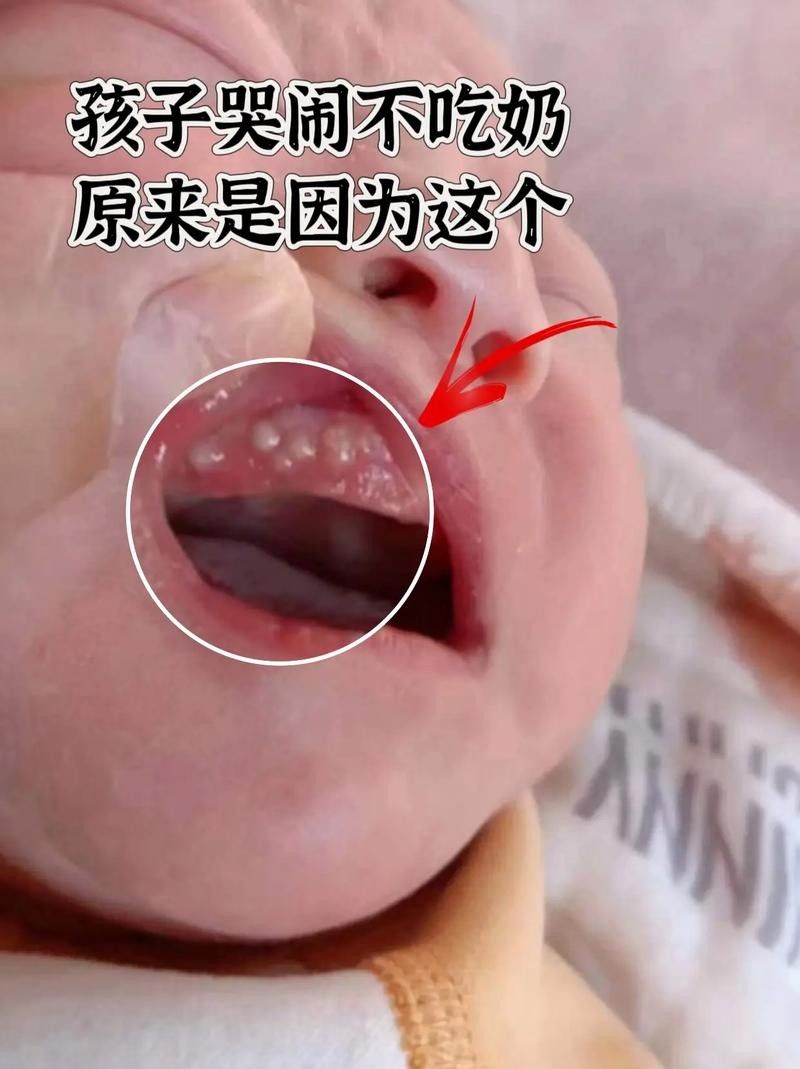寶寶嘴角內側的肉芽是由多種原因引起的，寶寶嘴角內側出現肉芽狀組織可能涉及多種情況，家長應立即就醫 寶寶嘴角內側的肉芽是由多種原因引起的，寶寶嘴角內側出現肉芽狀組織可能涉及多種情況，家長應立即就醫 觀賞魚百科 第19張