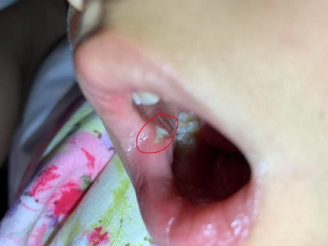 寶寶嘴角內側的肉芽是由多種原因引起的，寶寶嘴角內側出現肉芽狀組織可能涉及多種情況，家長應立即就醫 寶寶嘴角內側的肉芽是由多種原因引起的，寶寶嘴角內側出現肉芽狀組織可能涉及多種情況，家長應立即就醫 觀賞魚百科 第15張