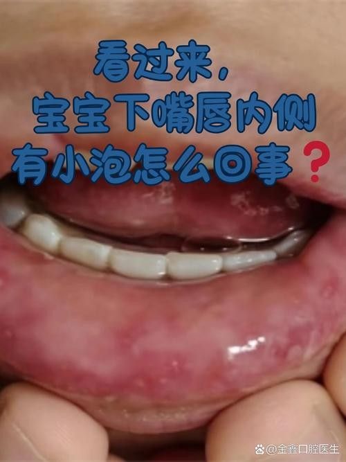 寶寶嘴角內側的肉芽是由多種原因引起的，寶寶嘴角內側出現肉芽狀組織可能涉及多種情況，家長應立即就醫 寶寶嘴角內側的肉芽是由多種原因引起的，寶寶嘴角內側出現肉芽狀組織可能涉及多種情況，家長應立即就醫 觀賞魚百科 第6張