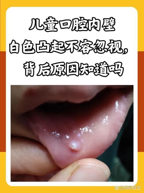 寶寶嘴角內側的肉芽是由多種原因引起的，寶寶嘴角內側出現肉芽狀組織可能涉及多種情況，家長應立即就醫 寶寶嘴角內側的肉芽是由多種原因引起的，寶寶嘴角內側出現肉芽狀組織可能涉及多種情況，家長應立即就醫 觀賞魚百科 第20張