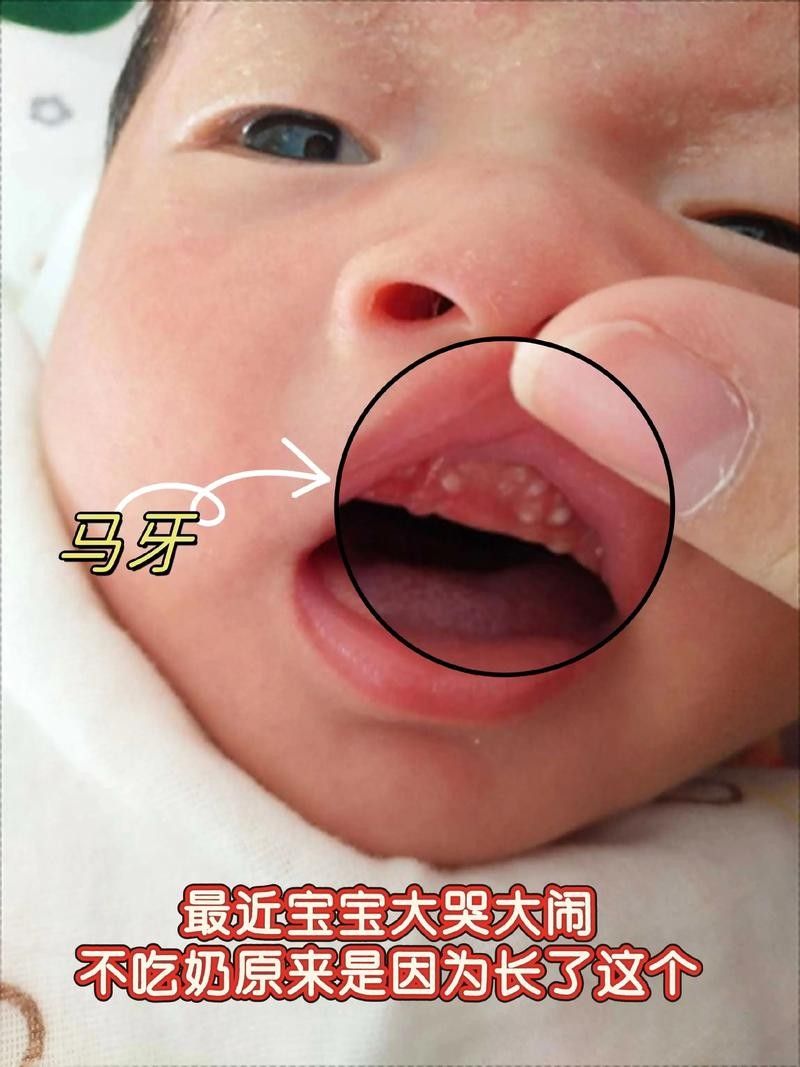 寶寶嘴角內側的肉芽是由多種原因引起的，寶寶嘴角內側出現肉芽狀組織可能涉及多種情況，家長應立即就醫 寶寶嘴角內側的肉芽是由多種原因引起的，寶寶嘴角內側出現肉芽狀組織可能涉及多種情況，家長應立即就醫 觀賞魚百科 第11張