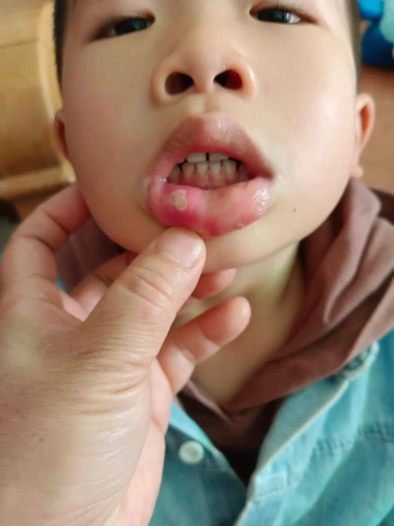 寶寶嘴角內側的肉芽是由多種原因引起的，寶寶嘴角內側出現肉芽狀組織可能涉及多種情況，家長應立即就醫 寶寶嘴角內側的肉芽是由多種原因引起的，寶寶嘴角內側出現肉芽狀組織可能涉及多種情況，家長應立即就醫 觀賞魚百科 第17張