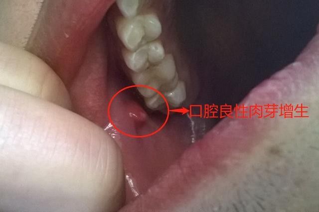 寶寶嘴角內側的肉芽是由多種原因引起的，寶寶嘴角內側出現肉芽狀組織可能涉及多種情況，家長應立即就醫 寶寶嘴角內側的肉芽是由多種原因引起的，寶寶嘴角內側出現肉芽狀組織可能涉及多種情況，家長應立即就醫 觀賞魚百科 第33張