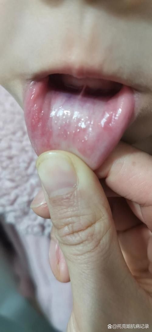 寶寶嘴角內側的肉芽是由多種原因引起的，寶寶嘴角內側出現肉芽狀組織可能涉及多種情況，家長應立即就醫 寶寶嘴角內側的肉芽是由多種原因引起的，寶寶嘴角內側出現肉芽狀組織可能涉及多種情況，家長應立即就醫 觀賞魚百科 第22張