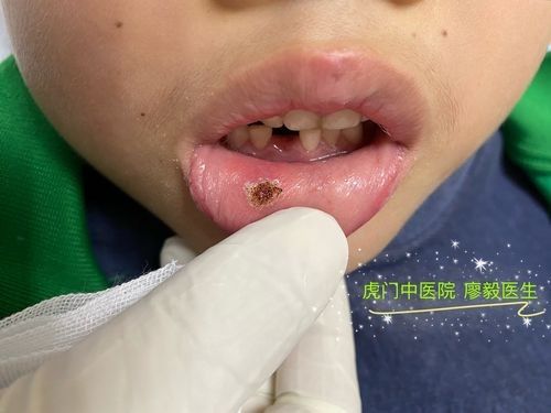 寶寶嘴角內側的肉芽是由多種原因引起的，寶寶嘴角內側出現肉芽狀組織可能涉及多種情況，家長應立即就醫 寶寶嘴角內側的肉芽是由多種原因引起的，寶寶嘴角內側出現肉芽狀組織可能涉及多種情況，家長應立即就醫 觀賞魚百科 第36張