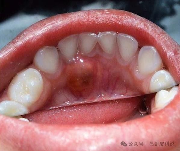 寶寶嘴角內側的肉芽是由多種原因引起的，寶寶嘴角內側出現肉芽狀組織可能涉及多種情況，家長應立即就醫 寶寶嘴角內側的肉芽是由多種原因引起的，寶寶嘴角內側出現肉芽狀組織可能涉及多種情況，家長應立即就醫 觀賞魚百科 第35張