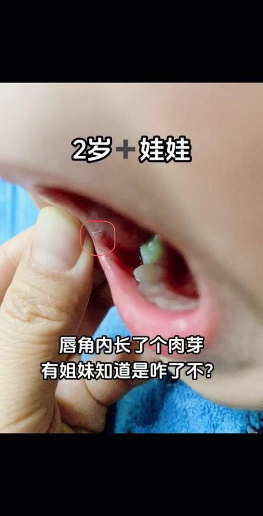 寶寶嘴角內側的肉芽是由多種原因引起的，寶寶嘴角內側出現肉芽狀組織可能涉及多種情況，家長應立即就醫 寶寶嘴角內側的肉芽是由多種原因引起的，寶寶嘴角內側出現肉芽狀組織可能涉及多種情況，家長應立即就醫 觀賞魚百科 第25張