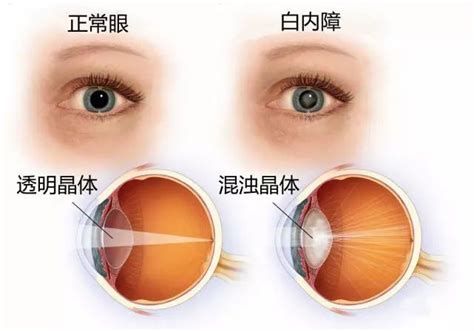 龍魚眼睛發白是怎么回事？（魚眼睛出現白色可能是由多種疾病引起的，詳細解讀及治療建議）