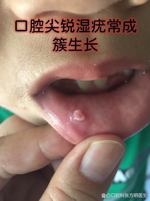 如何區分龍魚嘴上的肉疙瘩是病還是珠星？（龍魚嘴上的肉疙瘩是病嘴上的肉疙瘩是病嘴唇或吻端出現的）