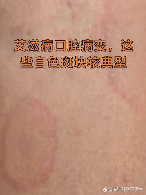 如何區分龍魚嘴上的肉疙瘩是病還是珠星？（龍魚嘴上的肉疙瘩是病嘴上的肉疙瘩是病嘴唇或吻端出現的）