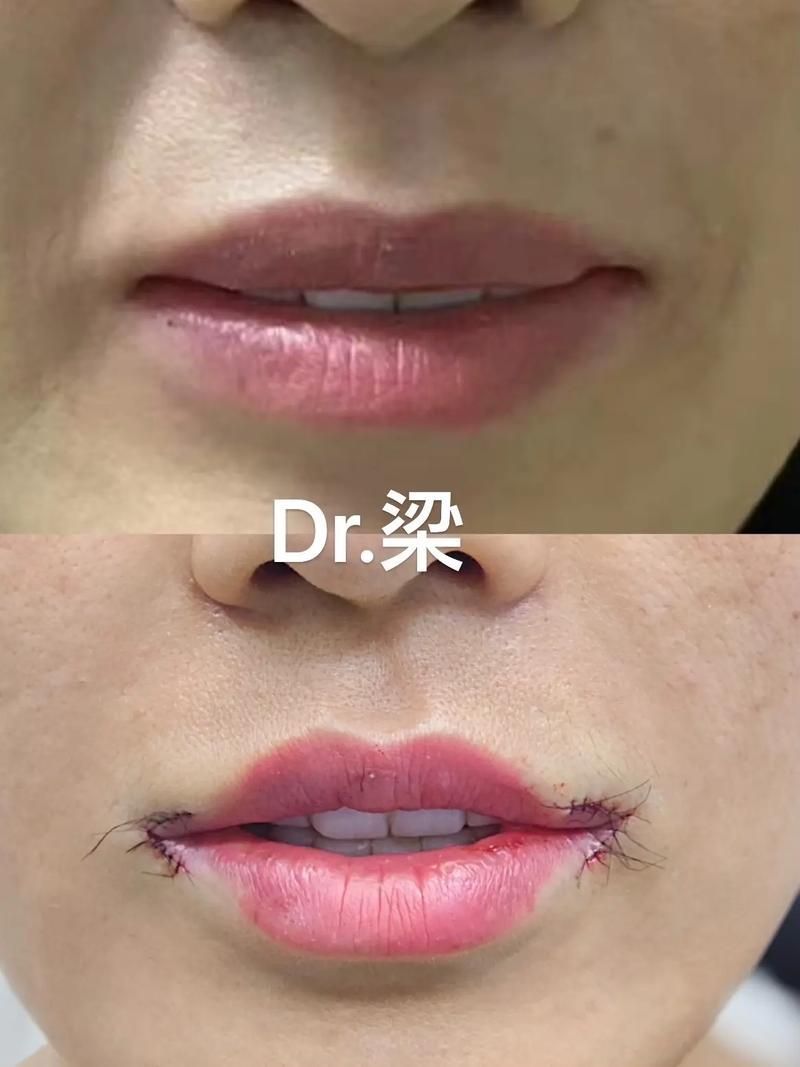 手術矯正龍魚嘴歪需要多長時間恢復？（手術矯正“龍魚嘴歪”并非醫學術語需召回與手術恢復過程）