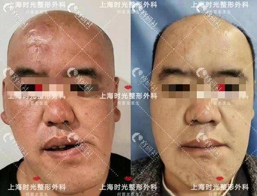 手術矯正龍魚嘴歪需要多長時間恢復？（手術矯正“龍魚嘴歪”并非醫學術語需召回與手術恢復過程）