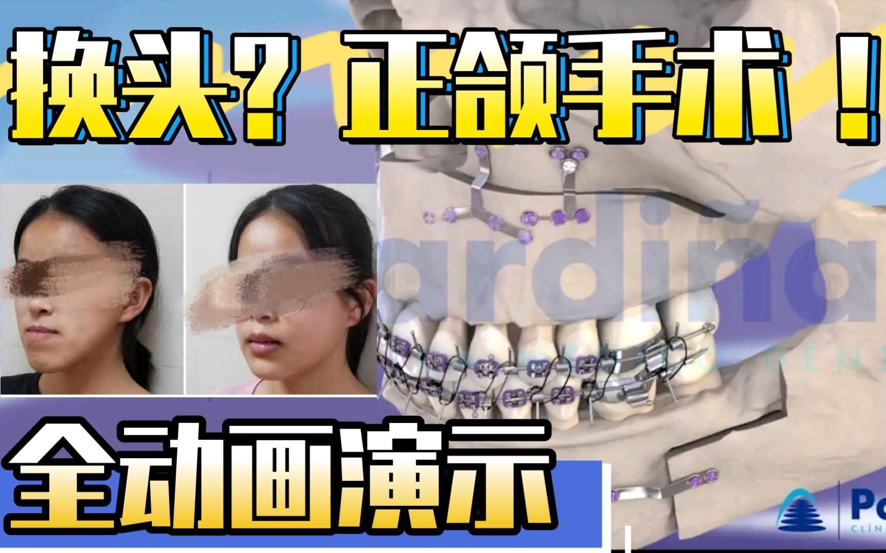 手術矯正龍魚嘴歪需要多長時間恢復？（手術矯正“龍魚嘴歪”并非醫學術語需召回與手術恢復過程）