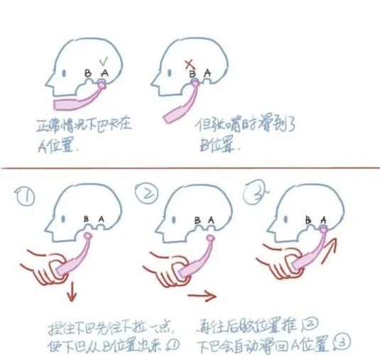 手術干預龍魚嘴巴脫臼的風險有多大？（手術干預龍魚嘴巴脫臼手術干預龍魚嘴巴脫臼的風險）