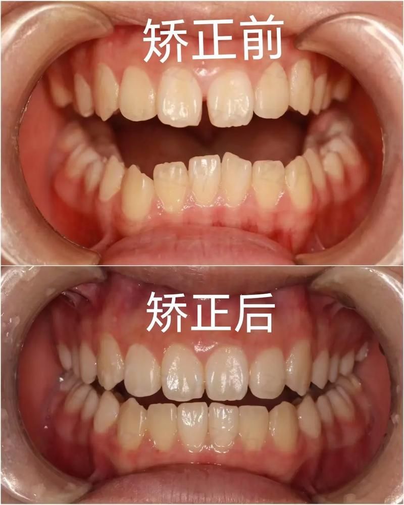 哪種方法矯正龍魚口合不攏最有效？（arxiv論文助手（arxiv論文助手）哪種方法矯正最有效）